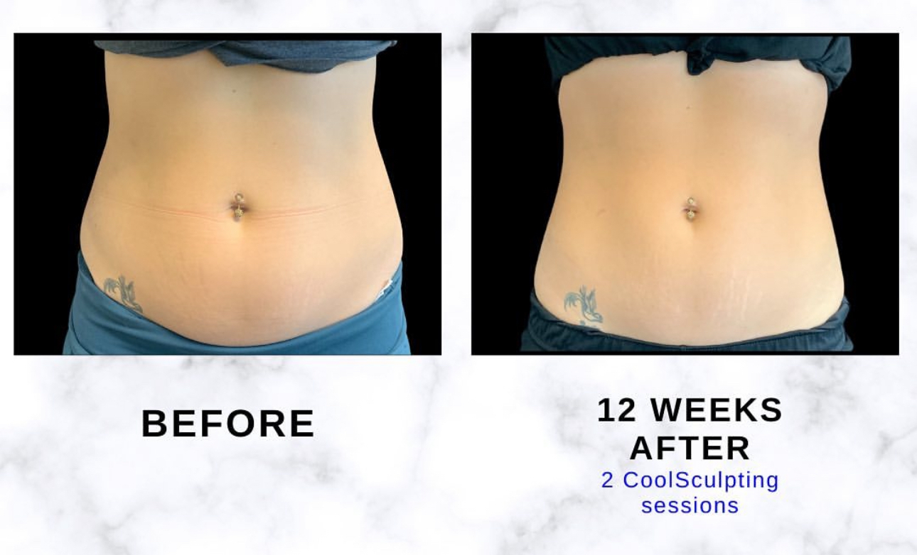 Abdomen front-view before and twelve weeks after two CoolSculpting sessions. Individual results vary.