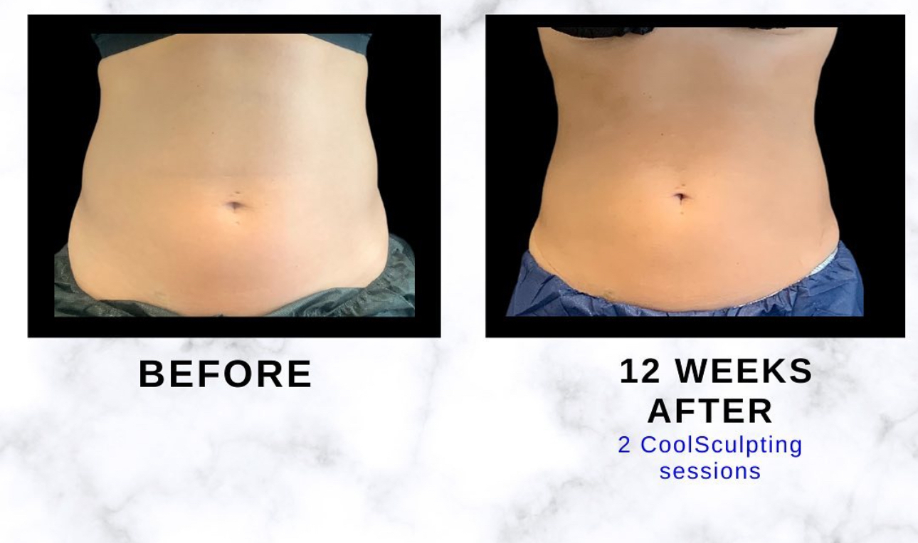 Abdomen front-view before and twelve weeks after two CoolSculpting sessions. Individual results vary.
