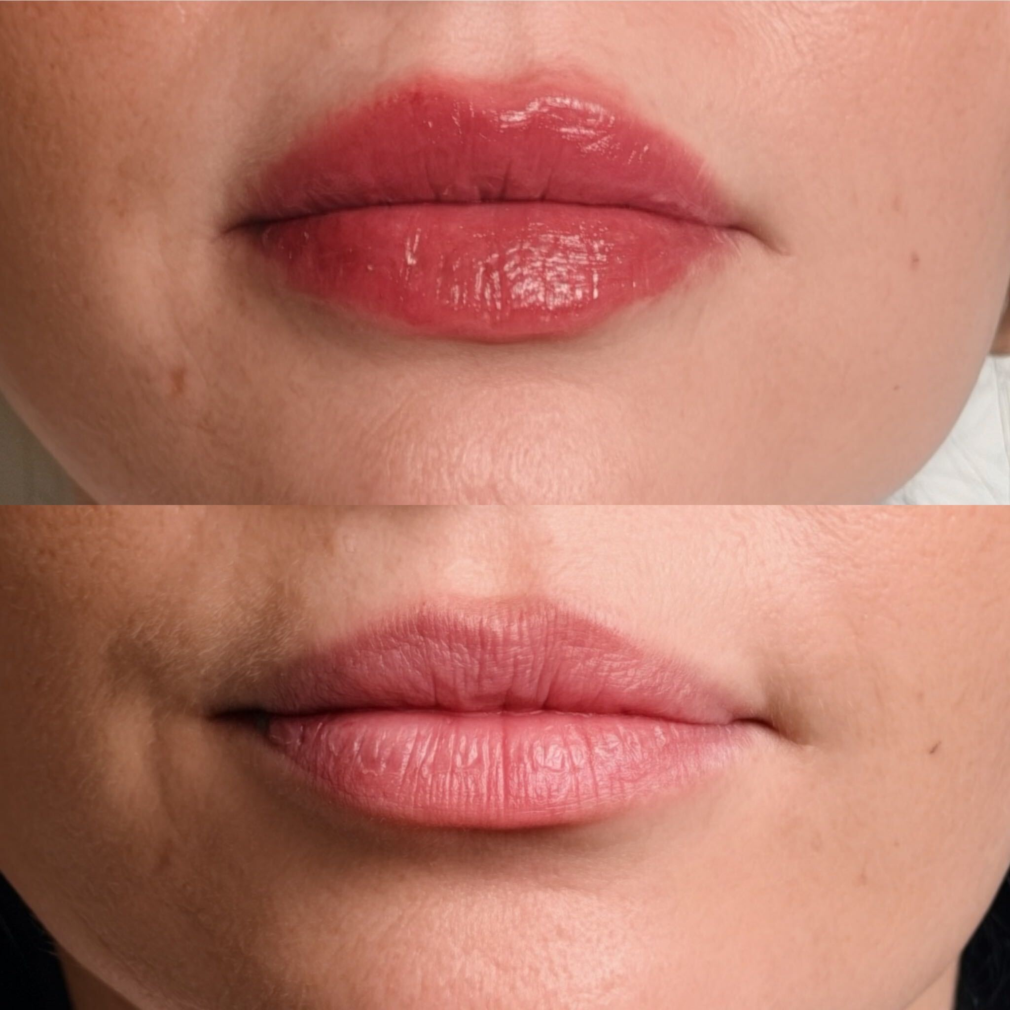 CC Lip Filler front-view before-and-after result. Individual results vary.